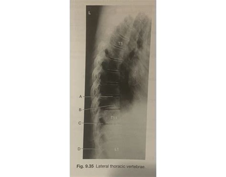 Lateral T-Spine X-ray Quiz